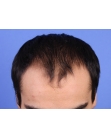 Before Hair Transplant&nbsp;Front